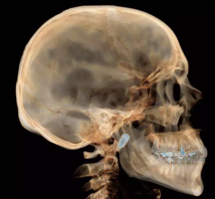 Photo of the IDF soldiers rare injury and the location of the bullet