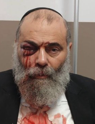 Haredi Jew Brutally Attacked in France After Leaving Mikvah