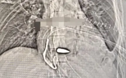 The bullet lodged in the soldiers heart