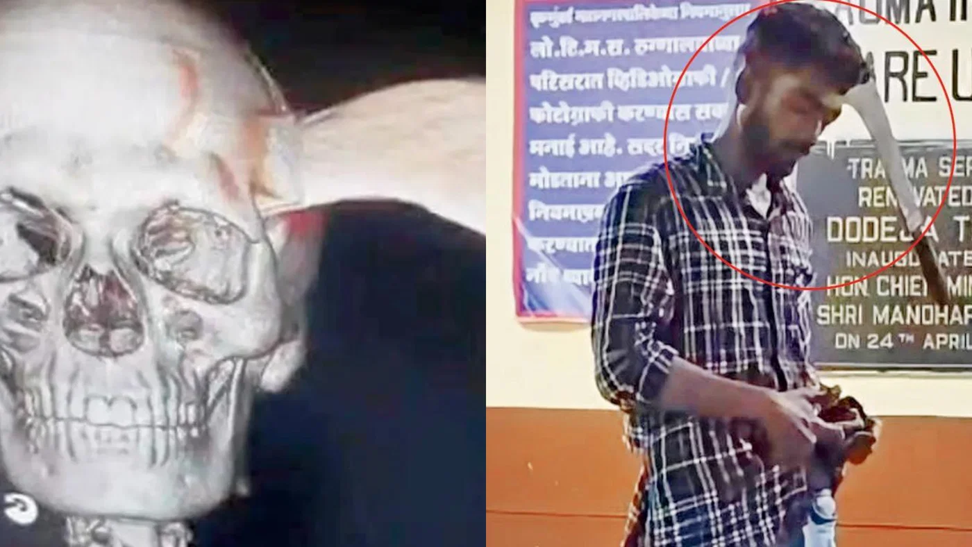 Walking Miracle: Mumbai Man Strolls into Hospital with Machete Embedded in his Brain