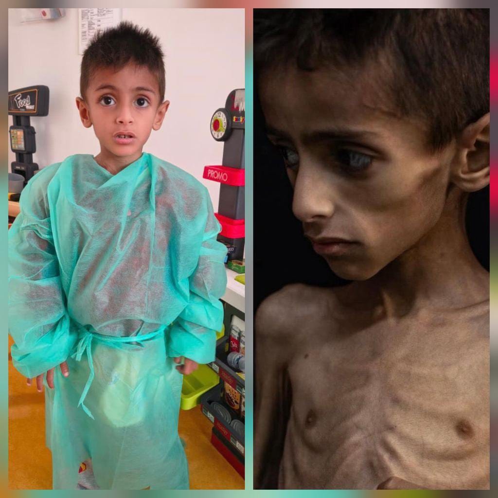 IDF Spokesman: The photo of 5-year-old Osama Al-Rakab is being misused to falsely accuse Israel of starving children.  Fact: Osama has a severe genetic illness, unrelated to the war. Israel coordinated his evacuation on June 12. He’s now receiving treatment in Italy.