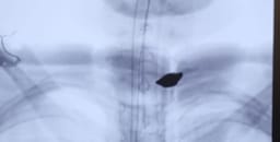 Photo of the shrapnel piece in X-ray of injured boy