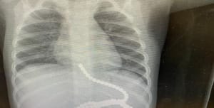 Xray showing the patient ingested many magnets