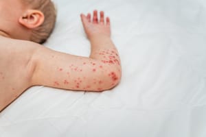 Measles