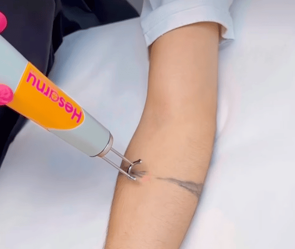 Rom Braslavski gets his tattoo removed