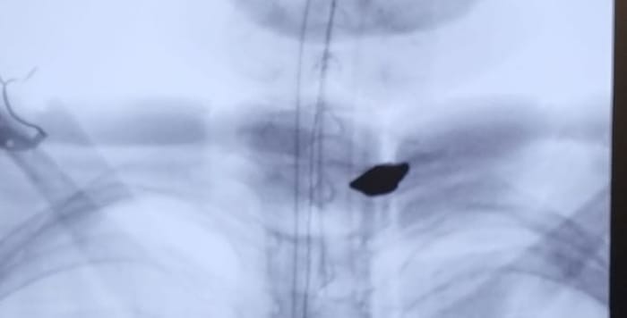 Photo of the shrapnel piece in X-ray of injured boy
