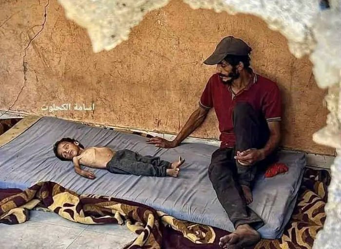 The viral photo of sick 'starving' Gaza child, 14 year old Abdul Qader al-Fayoumi