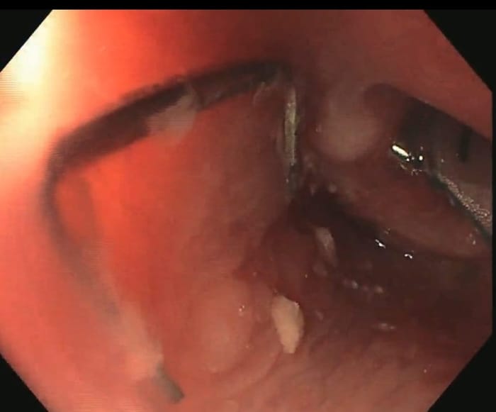 Staples Lodged in Esophagus