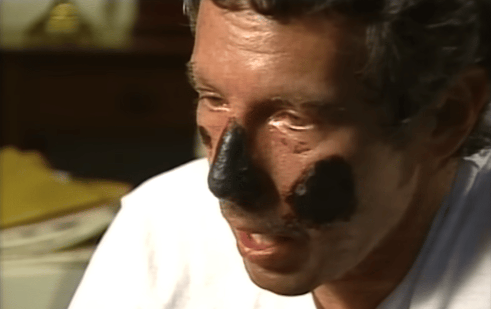 Beck Weathers with severe frostbite burns