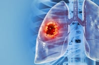 Lung cancer. Illustration.