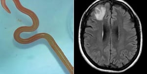 For the first time in the world: a parasitic worm was found in a human brain