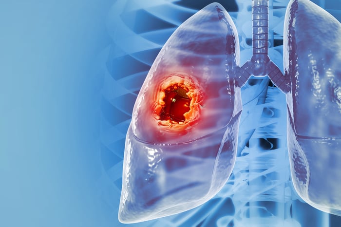 Lung cancer. Illustration.