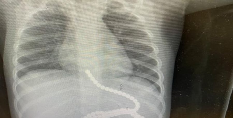 Xray showing the patient ingested many magnets