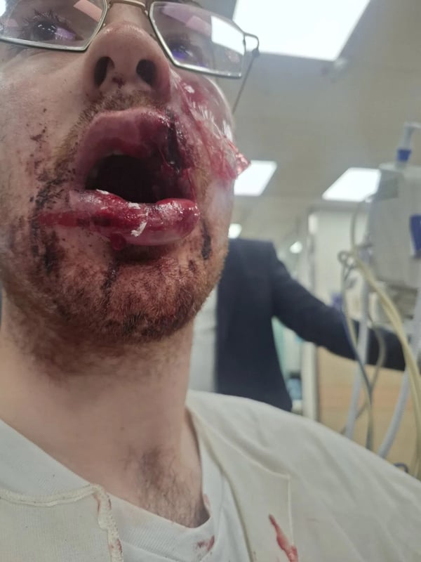 Haredi man injured by stun grenade