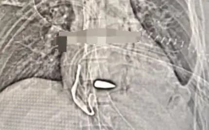 The bullet lodged in the soldiers heart