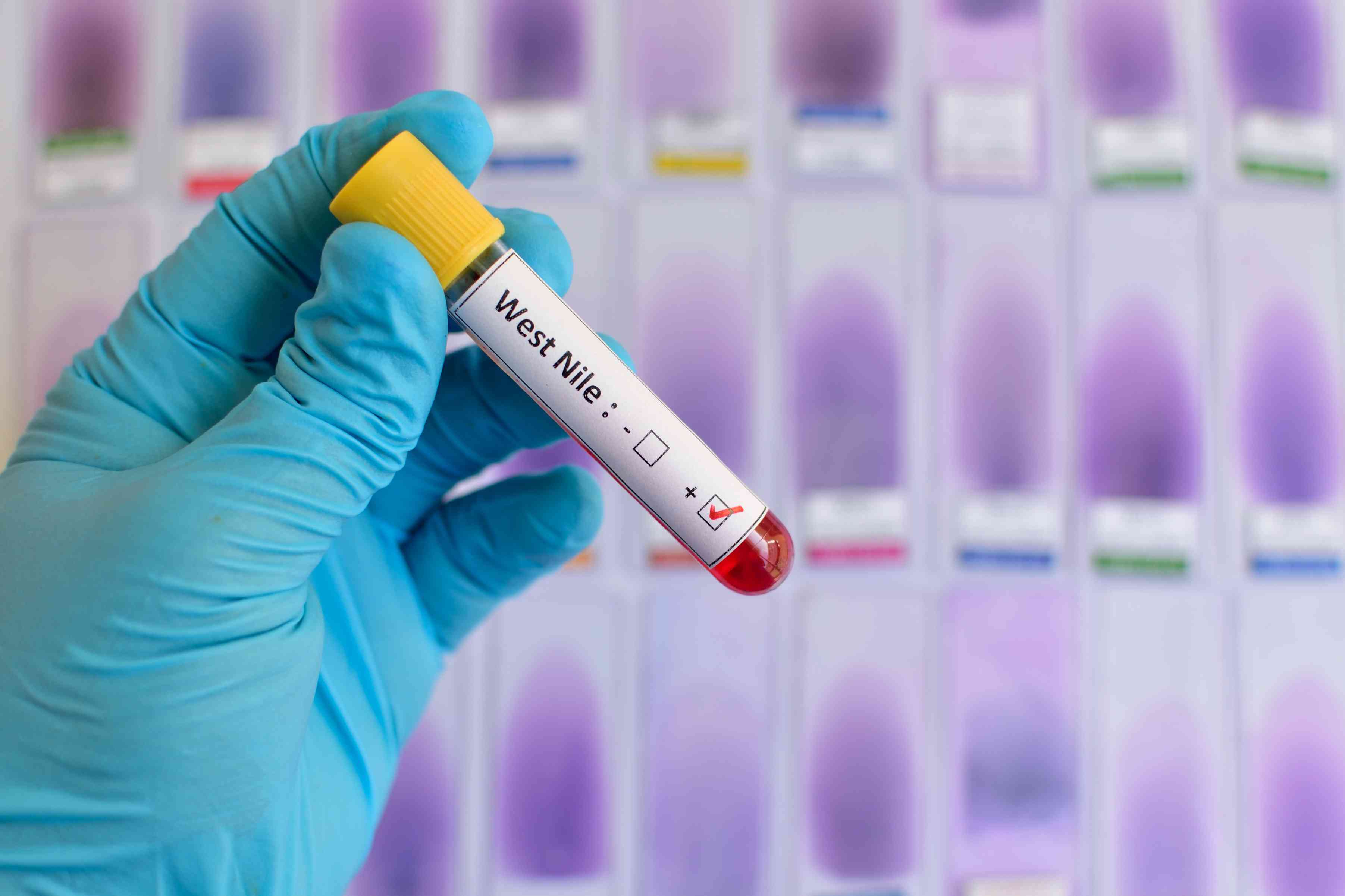 Blood sample positive with West Nile virus background