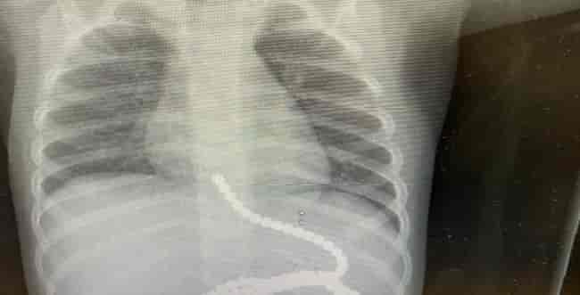 Xray showing the patient ingested many magnets background