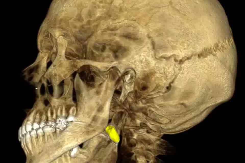 Photo of the IDF soldiers rare injury and the location of the bullet background