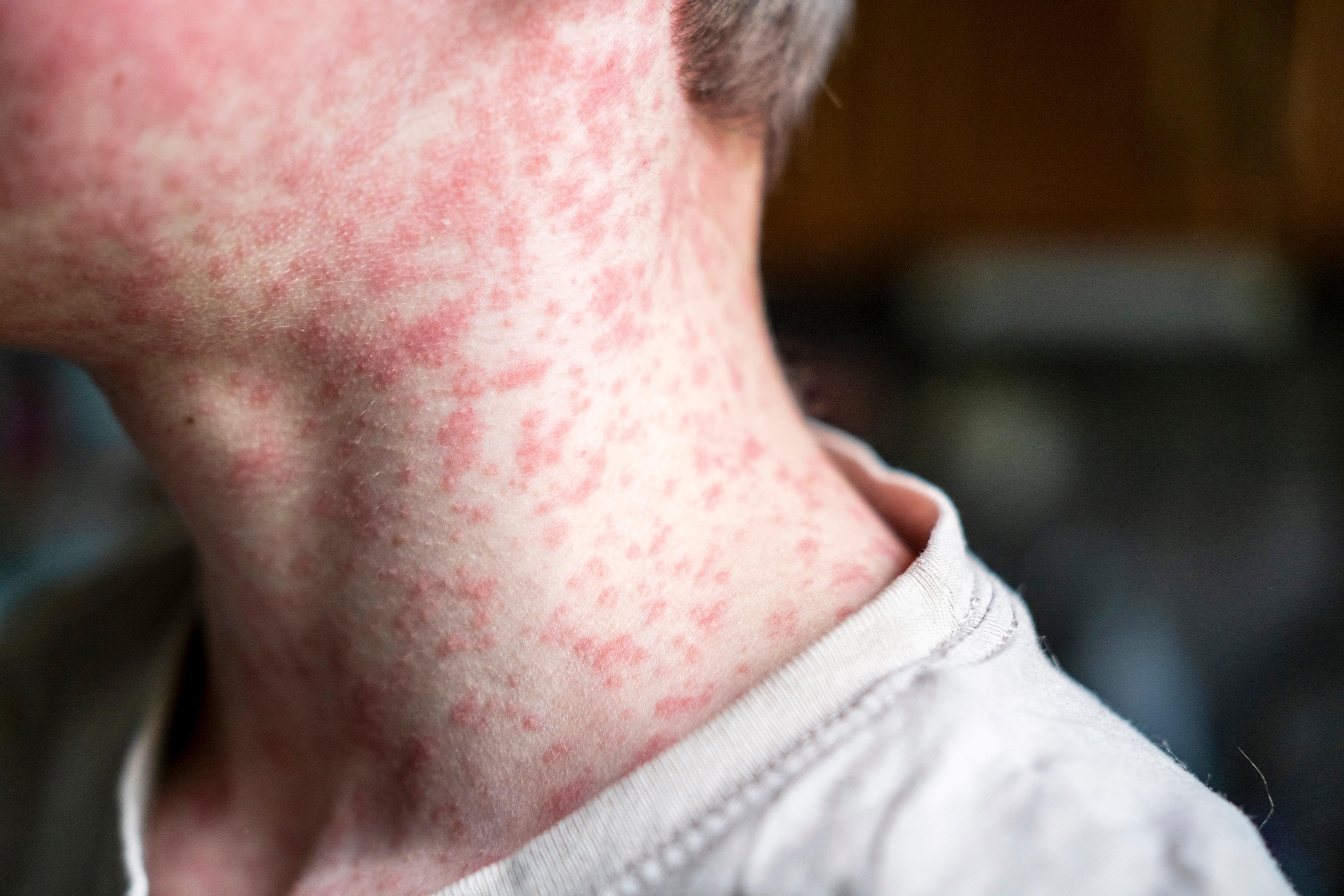 Measles   